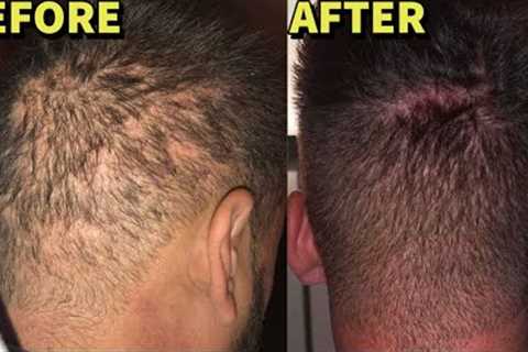 DESTROYED Donor Area RESURRECTED With MORE Hair Grafts!! **UNBELIEVEABLE**