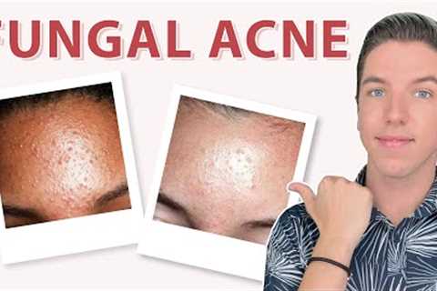 Little Bumps on Your Face &amp; How to Get Rid of Them