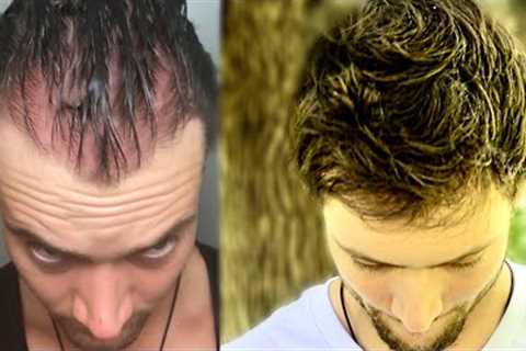 How I Quit The World’s Best Hair Loss Treatment and Regrew My Hair Naturally | Connor Murphy