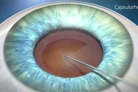 Cataract Surgery  Animation