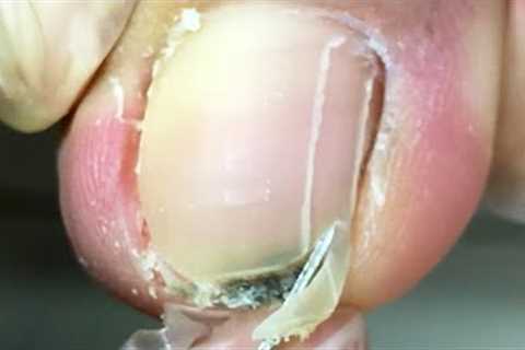 Black dirt hiding under toenails, clean up【Crazy pedicure room】