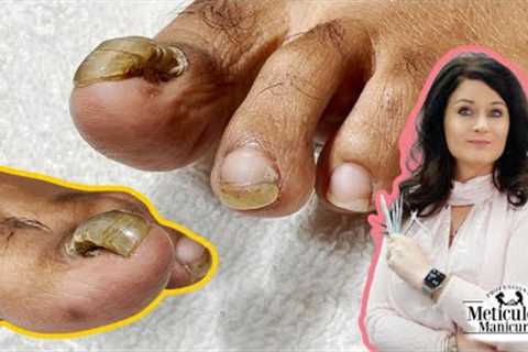 👣Tutorial on How to Care &amp; Treat a Detached Toenail with a Pedicure👣