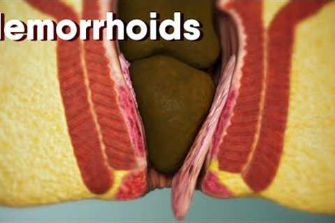 Hemorrhoids|different types of hemorrhoids| internal and external Hemorrhoids| Hemorrhoids treatment