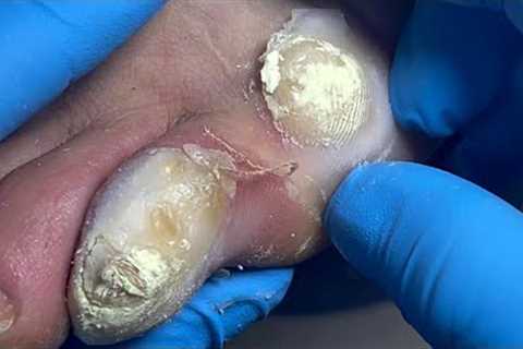 Remove dead toe skin and bad nails, nasty onychomycosis bacteria【Pedicure Master Lin Jun】
