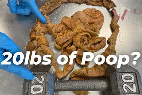 How Much Poop Is Stored in Your Colon??