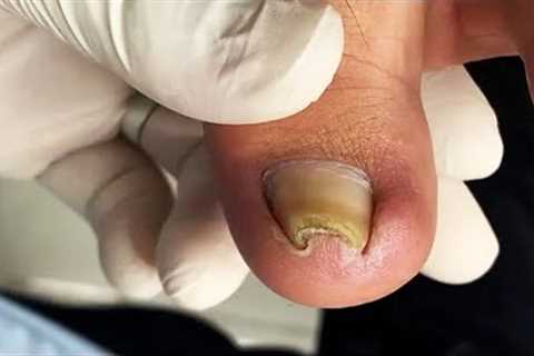 Removing Curly Ingrown Toenail | Professional pedicure