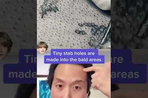 This is How Hair Transplant Surgery Works! #shorts #hairtransplant