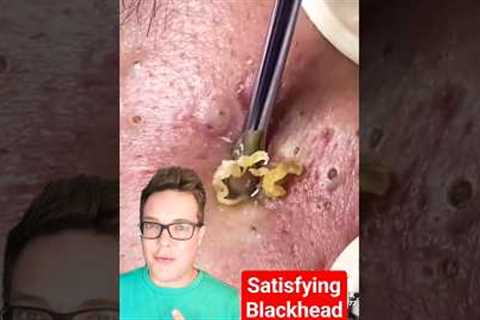 SATISFYING BLACKHEAD REMOVAL - Viewer Be Warned #shorts