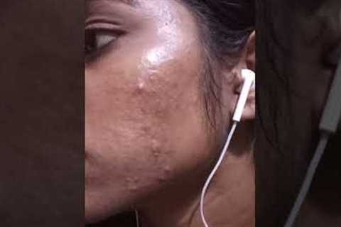 My pimple Transformation within 3 months secret revealed in Tamil / #missnithya
