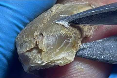 Super long onychomycosis, remove thick nails layer by layer【Pedicure Master Lin Jun】