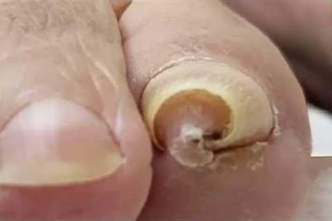 Pedicure Tutorial: fix super curly nails!