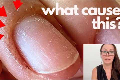 Swelling, pain, blisters after gel polish. Pro nail technician explains.