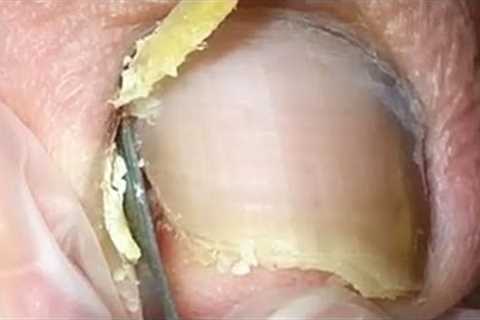The amazing amount of dead skin under the ingrown toenail!【Crazy pedicure room】