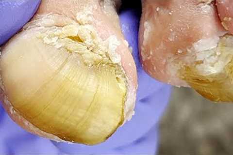 Woman's toenails curled like snail shells, professional pedicure【Xue Yidao】