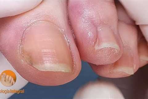 Growth control and routine nail cleaning [Podología Integral]