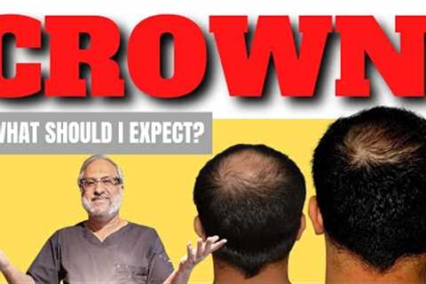 Hair transplant result for  Crown &amp; Vertex | Before and after Video by Dr Bhatti