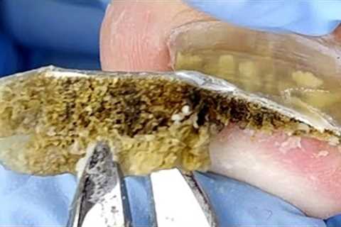 Wow~ The inside of the patient’s toenail is a hornet’s nest, very dark!【Xue Yidao】