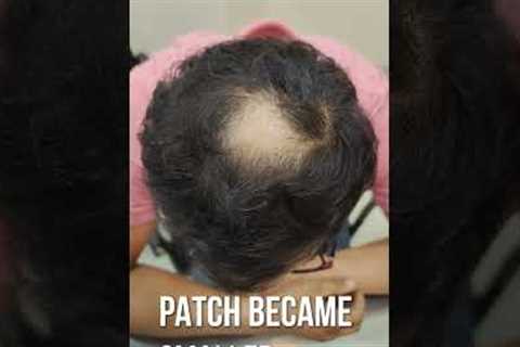 Treating Alopecia Areata to get full hair growth!