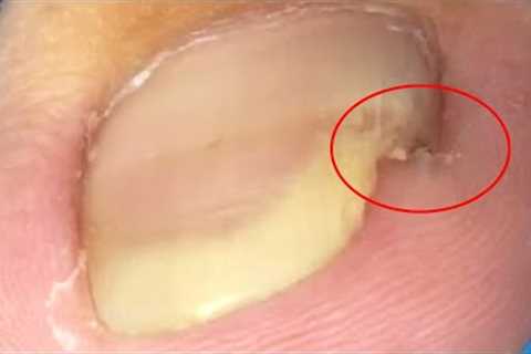 The ingrown toenail that broke on one side was finally treated【Crazy pedicure room】