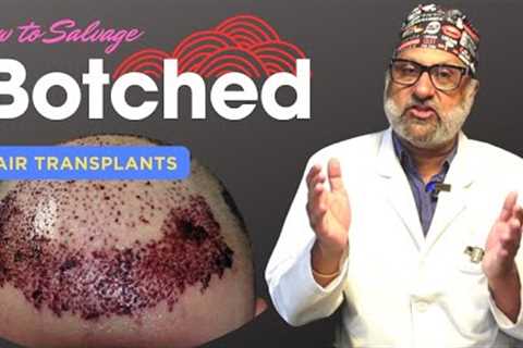 Hair Transplant in India Long-term Result after hair transplant repair