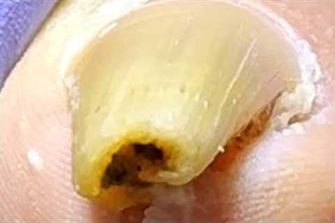 The ingrown toenail is rolled into a circle!Pedicure for a 63-year-old patient【Xue Yidao】