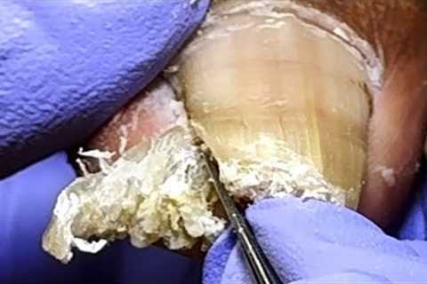 The huge ingrown toenail was cut off ~ professional pedicure【Xue Yidao】