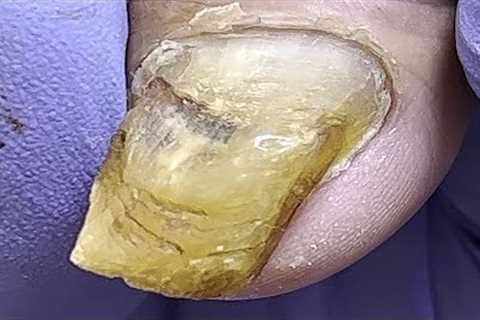 Perfect Gray Nail Manicure, So Comfortable!【Podiatry Clinic】#nail #pedicure