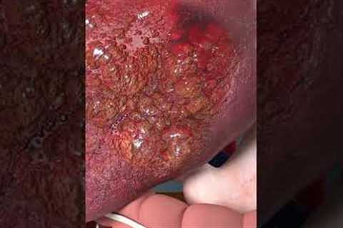 Watch What Happens To Your Body When You Use Steroids