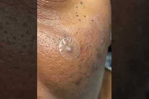 Pimple patch chronicles | acne meds Vol I | #pimplepoppers #pimplepatchpeel