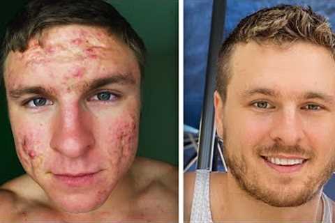 How I FINALLY Got Rid of My Acne!