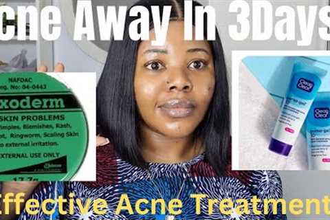 HOW TO DRY OUT YOUR ACNE IN 3DAYS | EFFECTIVE TREATMENTS. #acne #acnetreatment #benzoylperoxide #2k