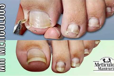 👣IMPACTED TOENAIL Gunk Removal on Mr. Meticulous👣