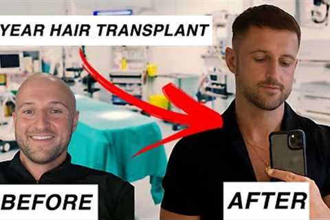 My 1 YEAR Hair Transplant Result! CRAZY!!