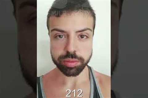 Hair Transplant Time Lapse - Day 1 to Day 347 - 1 Year Result