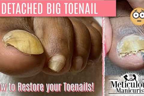 👣How To Pedicure Transformation for Men on Detached Toenails👣