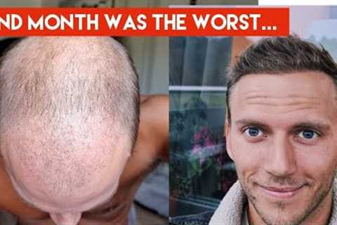 My Hair Transplant Journey - The AWFUL first 4 months (in-depth walkthrough week by week)