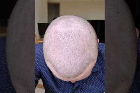 Hair Transplant Growth Timeline #shorts