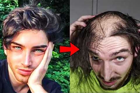 24 Year Old Model Had A Transplant But Stopped Taking Hair Loss Meds And This Is What Happened