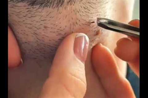 Blackheads extractions-this week | massive old Blackhead on the Neck