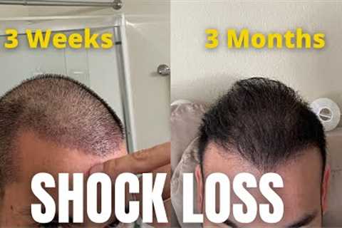 When Do Hair Transplants Start To Grow? Prepare Yourself Mentally For Surgery