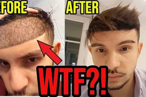 The LOWEST Hairline I’ve EVER Seen From A Hair Transplant!! **UNBELIEVABLE**