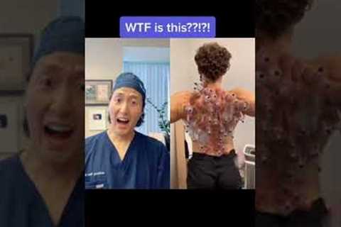 Extreme Cupping Therapy! #shorts #cupping