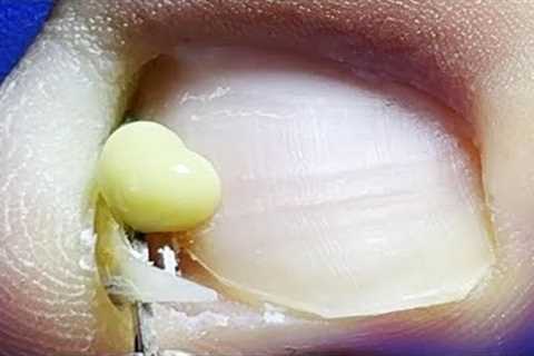 Wow~ The toenails are sick and inflamed~【Xue Yidao】