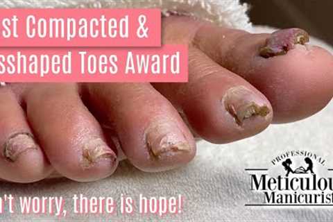 👣How to Pedicure Transformation the Most Compacted &amp; Misshapen Toenails👣