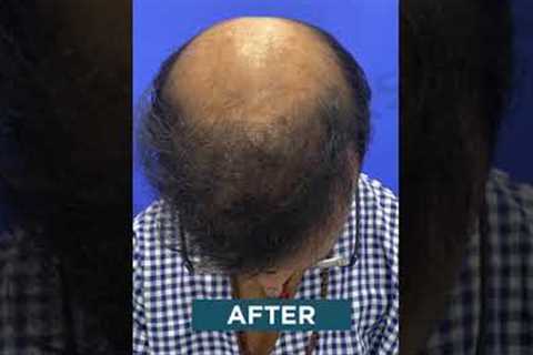 ✅1st Hair Transplant Results #shorts #hair