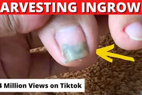 Ingrown Toenails Treatment-Alma's Manicure and Pedicure Vlogs-Joyful Initial Result