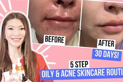 Skin Care Routine Acne Oily Skin | How I Got Clear Skin in 30 Days
