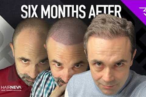 Best Hair Transplant In Turkey - DHI 6 months results