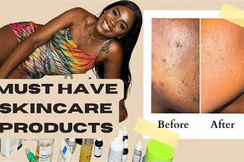 MUST HAVE SKINCARE PRODUCTS | BLACK GIRL Skincare|  Acne TREATMENT| Skincare routine