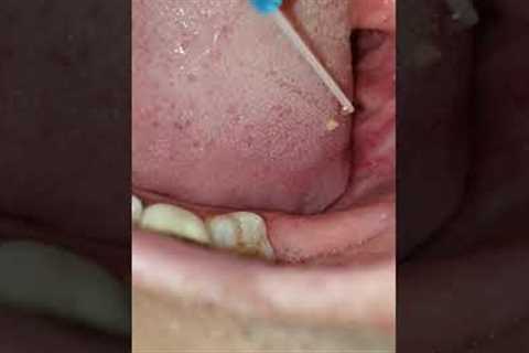 Flushing out tonsil stones 2
